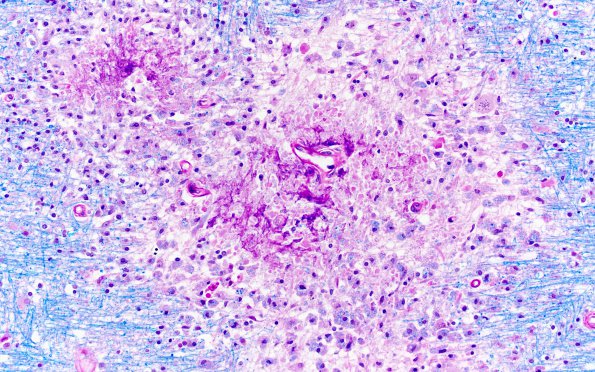 2A4 HIV Leukoencephalitis (Case 2) LFB-PAS 6