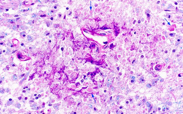 2A5 HIV Leukoencephalitis (Case 2) LFB-PAS 6 copy