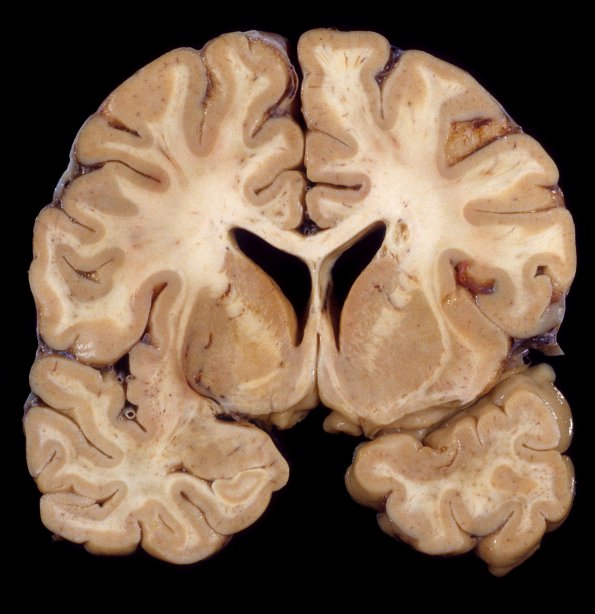 3A1 Encephalitis, HIVL (& minor HIVE) (Case 3) 2