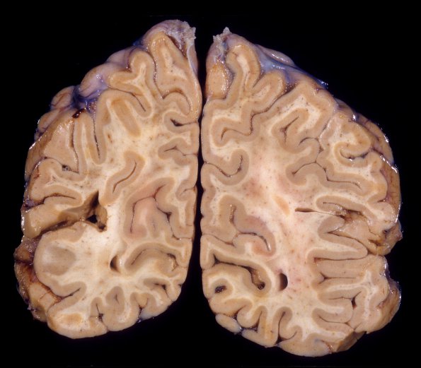 3A2 Encephalitis, HIVL (& minor HIVE) (Case 3) 3