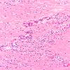 3B1 Encephalitis, HIVL (& minor HIVE) (Case 3) H&E 40X
