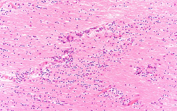 3B1 Encephalitis, HIVL (& minor HIVE) (Case 3) H&E 40X