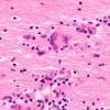 3B2 Encephalitis, HIVL (& minor HIVE) (Case 3) H&E 60X