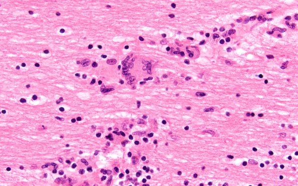 3B2 Encephalitis, HIVL (& minor HIVE) (Case 3) H&E 60X