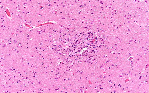 3B3 Encephalitis, HIVL (& minor HIVE) (Case 3) N6 H&E 3