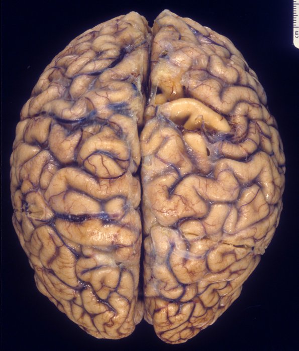 4A1 HIVL (& lesser HIVE) (Case 4) 2