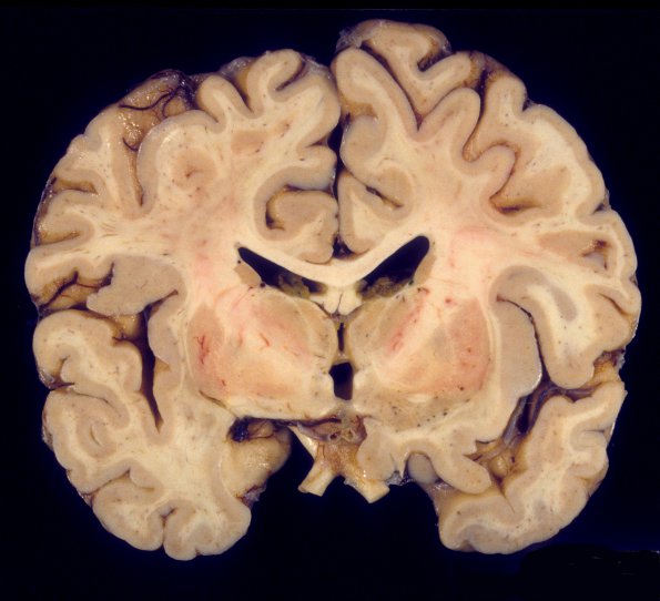 4A2 HIVL (& lesser HIVE) (Case 4) 1A