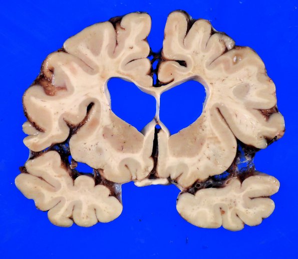 5A2 HIV Encephalitis, HIVE & HIVL (Case 5) 4