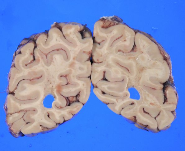 5A3 HIV Encephalitis, HIVE & HIVL (Case 5) 2