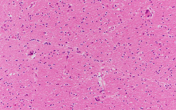 6B3 HIVE & HIVL (Case 6) H&E N2 11