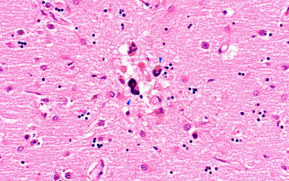 6B6 HIVE & HIVL (Case 6) H&E N2 12 copy