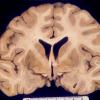 7A1 Encephalitis, HIV, very mild granular ependymitis & Perivascular cuffing (Case 7) 1