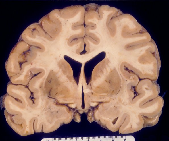 7A1 Encephalitis, HIV, very mild granular ependymitis & Perivascular cuffing (Case 7) 1