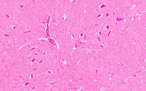 7B Encephalitis, HIV, very mild granular ependymitis & Perivascular cuffing (Case 7) H&E 1A