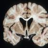 8A1 HIV Encephalitis-Leukoencephalitis (Case 8) 1