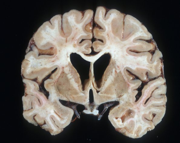 8A1 HIV Encephalitis-Leukoencephalitis (Case 8) 1