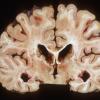 8A2 HIVE, HIVL, CMV Encephalitis (Case 8) 2