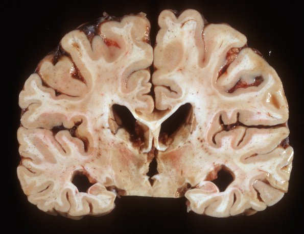 8A2 HIVE, HIVL, CMV Encephalitis (Case 8) 2