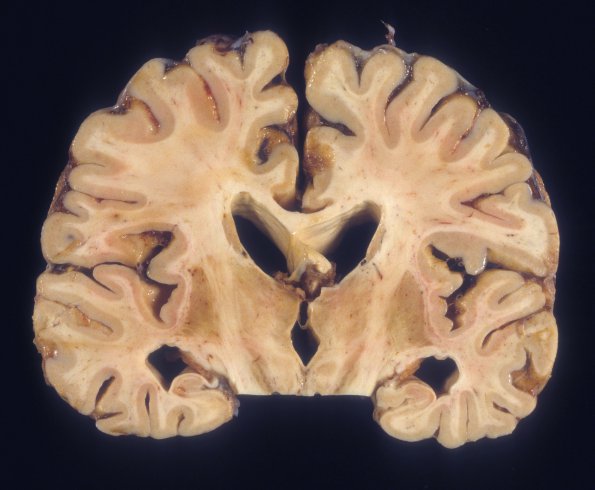 8A3 HIVE, HIVL, CMV Encephalitis (Case 8) 2