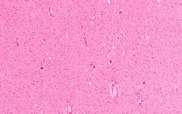 8B1 HIVE, HIVL, CMV Encephalitis (Case 8) H&E N11 3