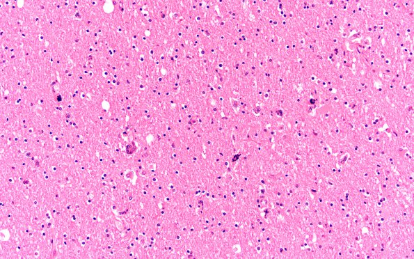 8B2 HIV Leukoencephalitis (Case 8) H&E N11 1