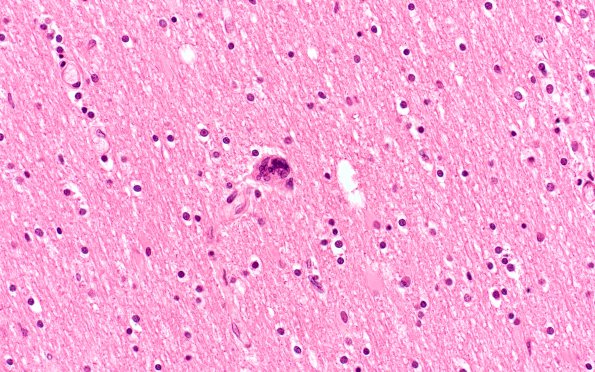 8B3 HIVE, HIVL, CMV Encephalitis (Case 8) H&E N13 2