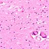 8B4 HIV Leukoencephalitis (Case 8) H&E N3 1