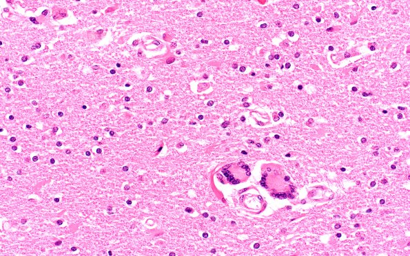 8B4 HIV Leukoencephalitis (Case 8) H&E N3 1
