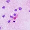 2B4 HSV I Encephalitis (Case 2) H&E smear 2
