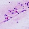 2B5 HSV I Encephalitis (Case 2) H&E smear 5