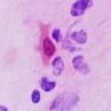 2B6 HSV I Encephalitis (Case 2) H&E smear 4