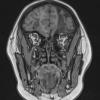 2E1 HSV-I Encephalitis, 15 years prior (Case 2) T1 MPHRAGE 2 - Copy