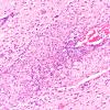 3B4 Herpes Simplex I Encephalitis (Case 3) H&E 2