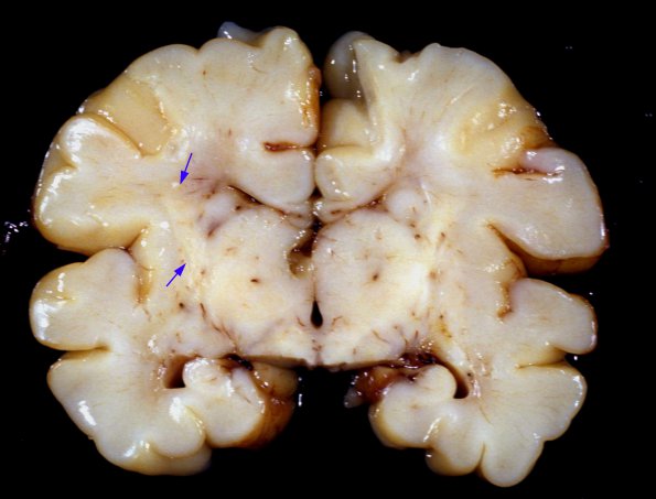 1A1 HSV-II encephalitis, neonatal (Case 1) 1 copy