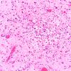1B HSV-II encephalitis, neonatal & hypoxia (Case 1) HSV2 IHC 5A