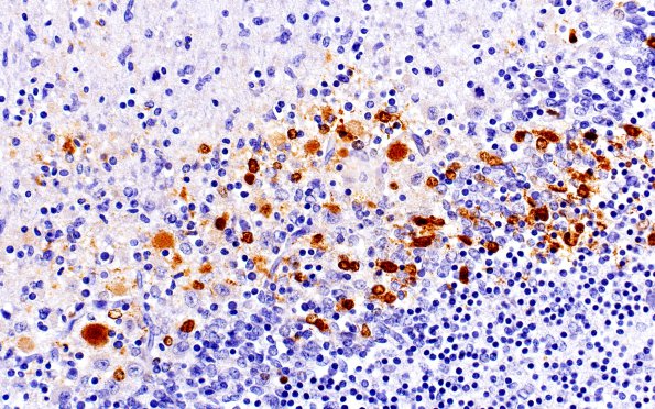 1C3 HSV-II encephalitis, neonatal (Case 1) HSV-2 IHC 2