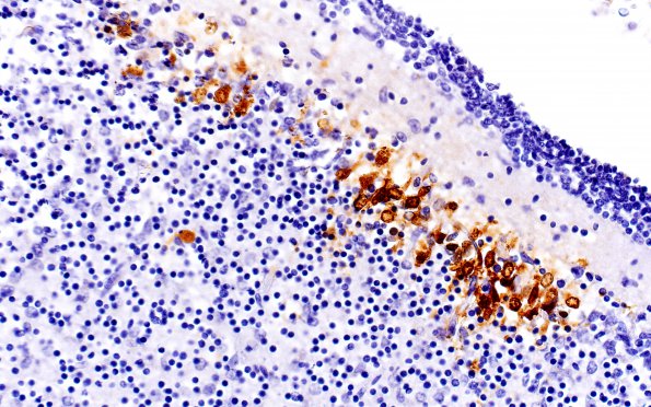 1C4 HSV-II encephalitis, neonatal (Case 1) HSV-2 IHC 5