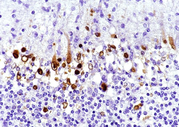 1C5 HSV-II encephalitis, neonatal (Case 1) HSV2 IHC 1