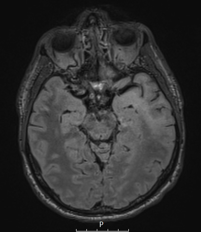 1A1 PML (Case 1) FLAIR 3 - Copy