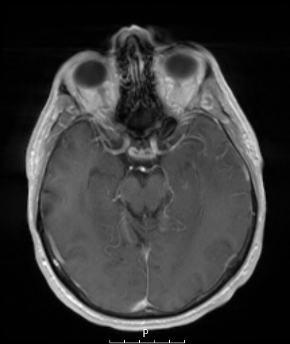 1A3 PML (Case 1) T1W 4 - Copy