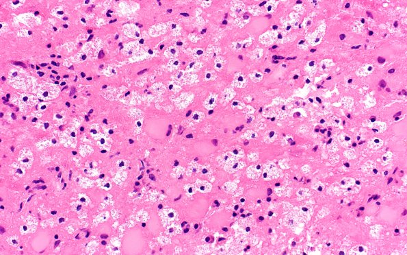 1B4 PML (Case 1) H&E 40X 4