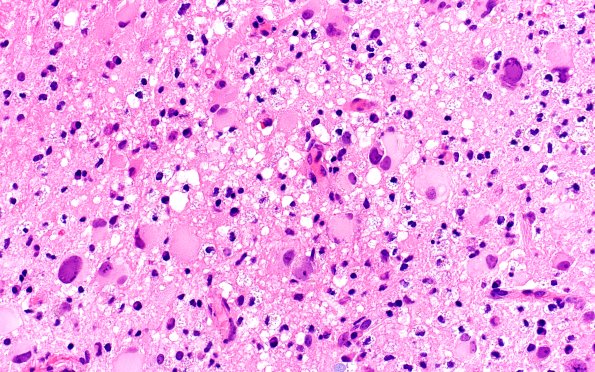 1B7 PML (Case 1) H&E 40X 9 (B2)