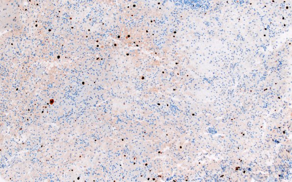 1I1 PML (Case 1) Ki67 10X