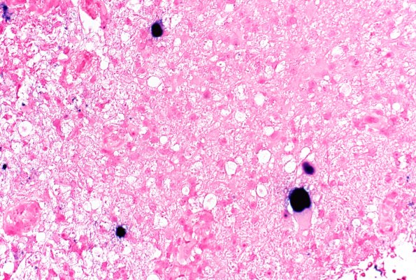 1J3 PML (Case 1) JCV ISH 40X 2