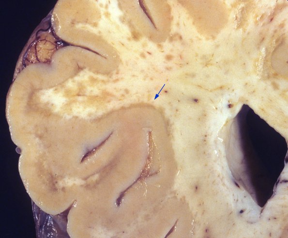 1A2 PML (Case 1) 6 (U-fibers not spared) copy