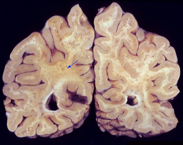 1A3 PML (Case 1) 2 copy