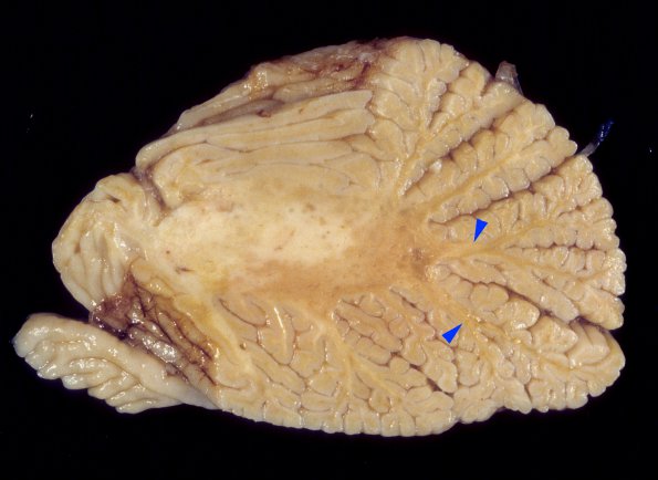 1A5 PML (Case 1) A9 copy