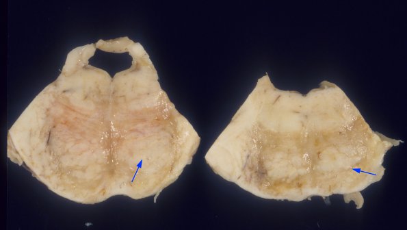 2A2 PML (Case 2) A8 copy