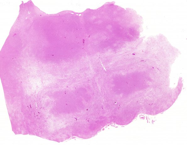 2B1 PML (Case 2) spare corticospinal tract H&E whole mount