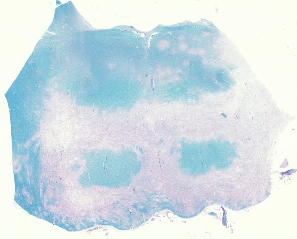 2B2 PML (Case 2) spare corticospinal tract LFB-PAS whole mount